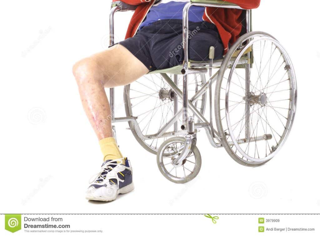 amputation personal injury lawyer utah