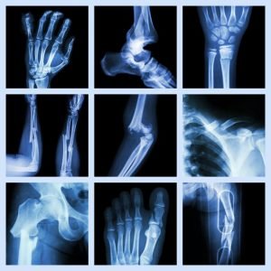 pic-bones x-ray bones