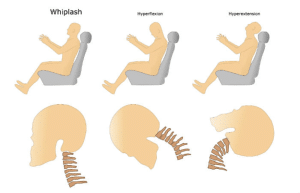 whiplash whiplash, hyperflexion, hyperextension